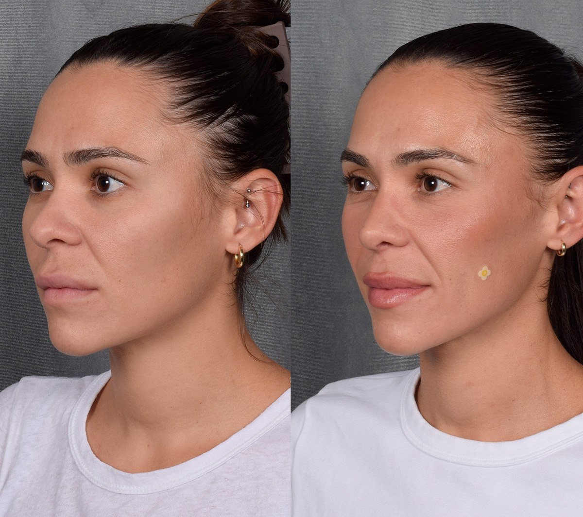Rhinoplasty Before & After Gallery - Patient 260178 - Image 3