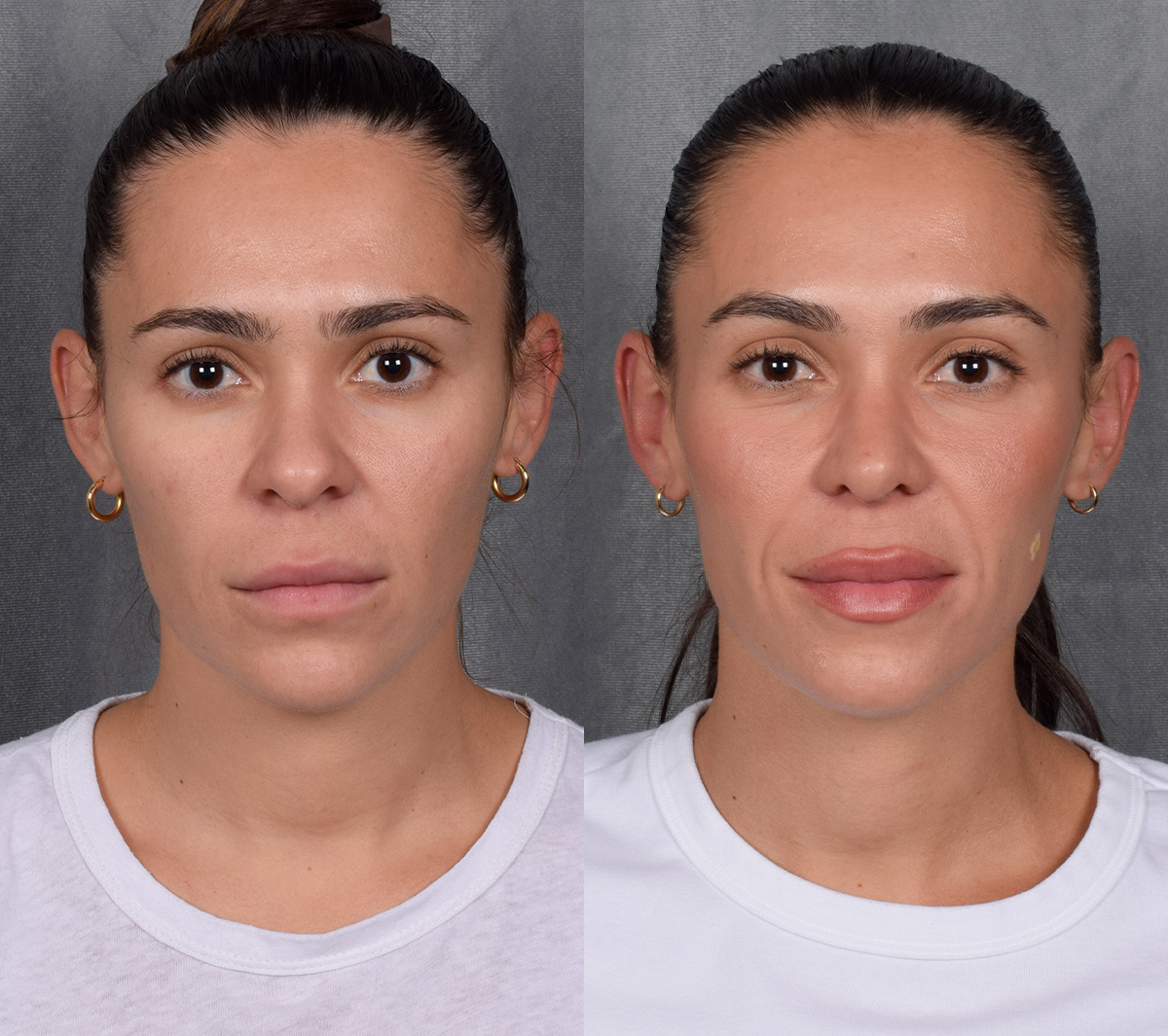 Rhinoplasty Before & After Gallery - Patient 260178 - Image 4