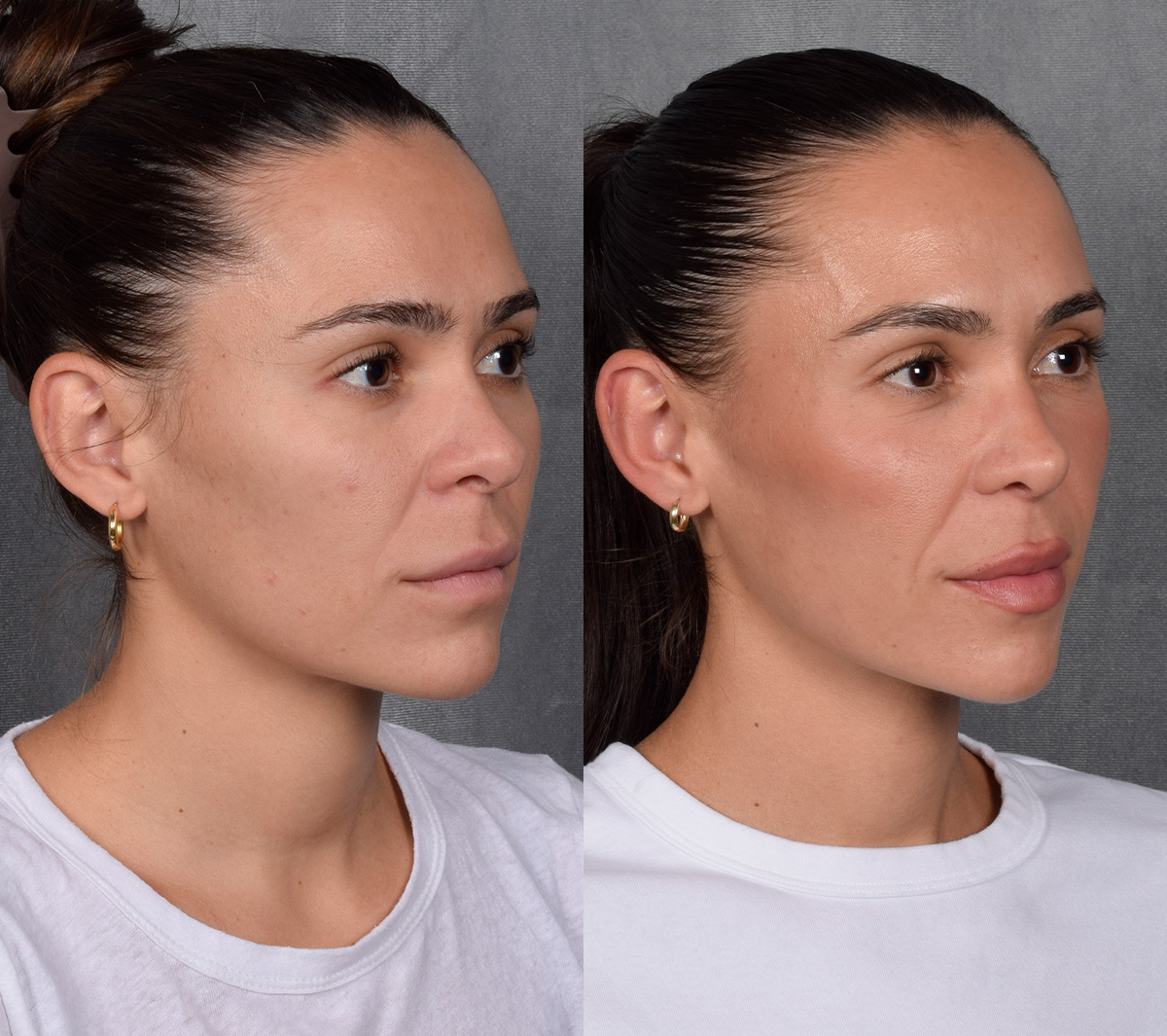 Rhinoplasty Before & After Gallery - Patient 260178 - Image 6