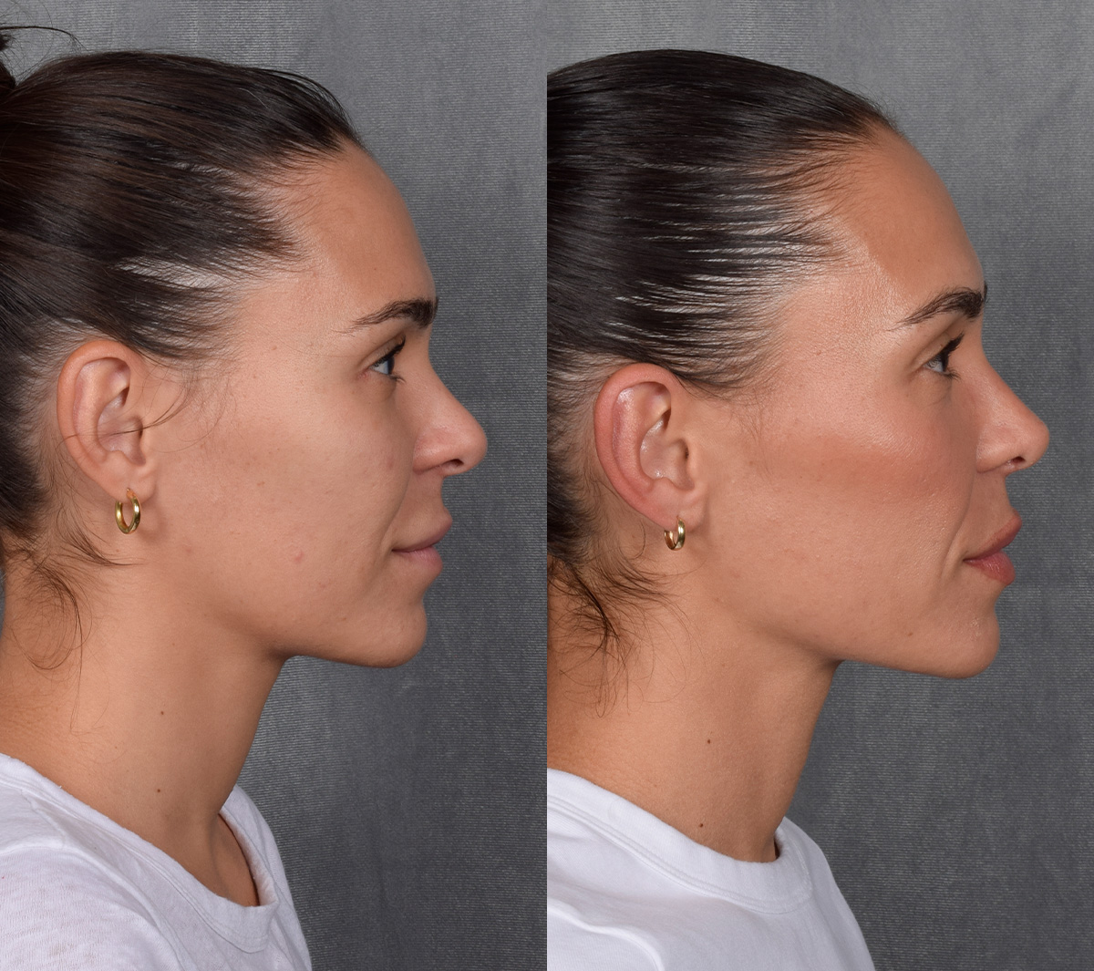 Rhinoplasty Before & After Gallery - Patient 260178 - Image 7