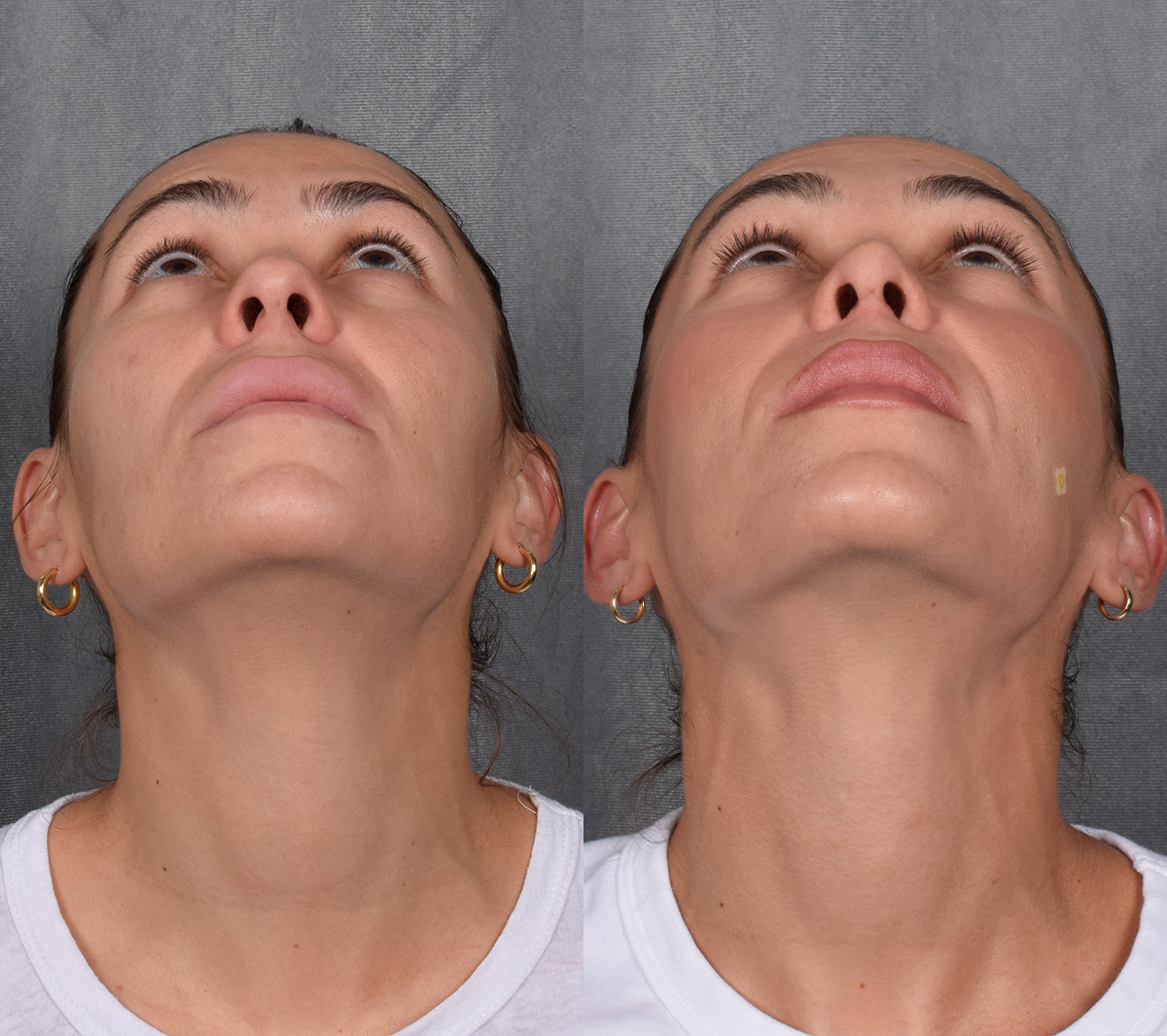 Rhinoplasty Before & After Gallery - Patient 260178 - Image 5