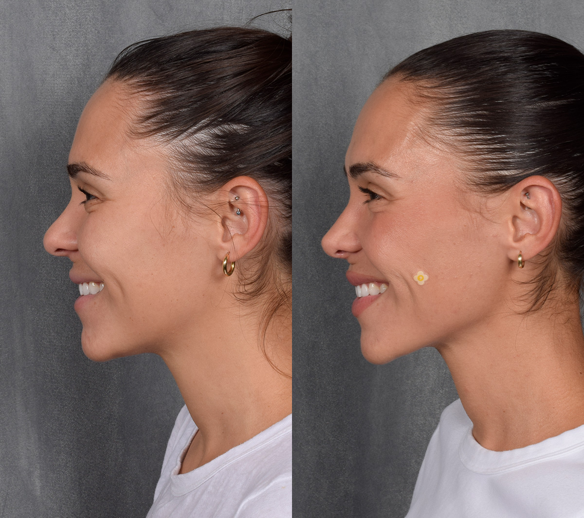 Rhinoplasty Before & After Gallery - Patient 260178 - Image 1