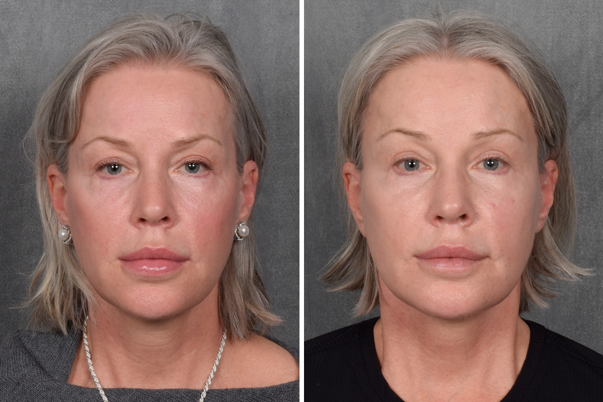 Facelift Before & After Gallery - Patient 171995 - Image 2