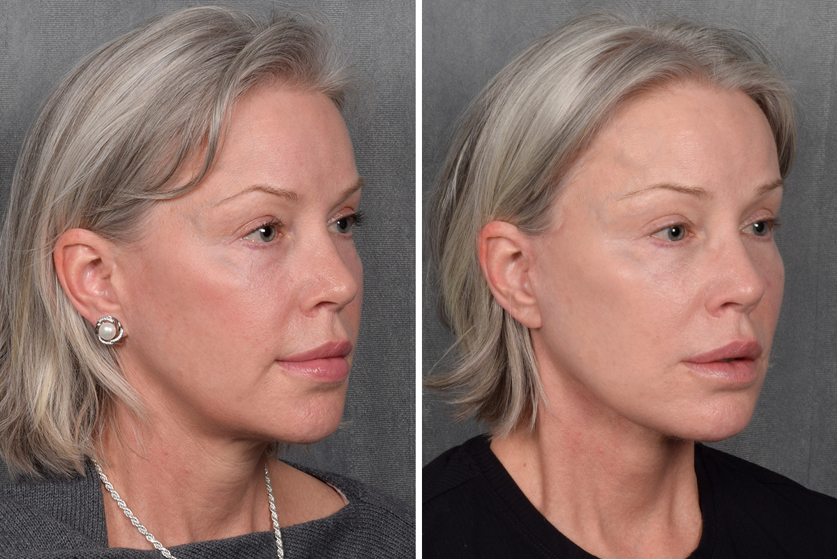Facelift Before & After Gallery - Patient 171995 - Image 3