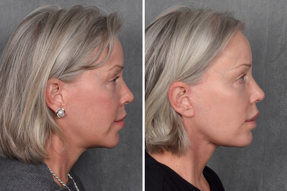 Facelift Before & After Gallery - Patient 171995 - Image 4