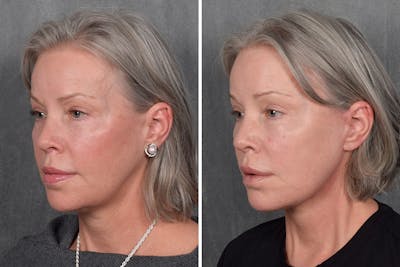 Facelift Before & After Gallery - Patient 171995 - Image 1
