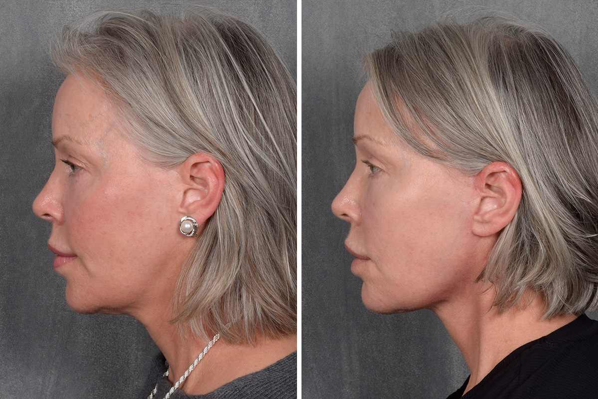 Facelift Before & After Gallery - Patient 171995 - Image 5