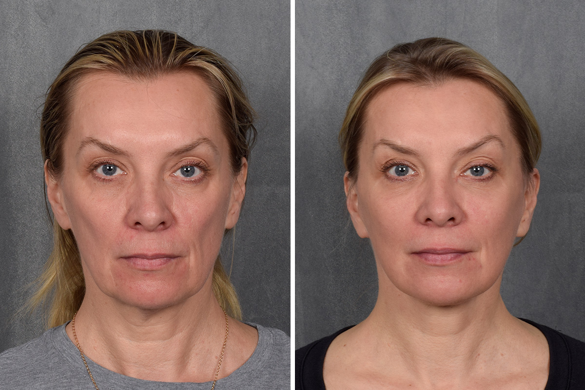 Facelift Before & After Gallery - Patient 365947 - Image 3