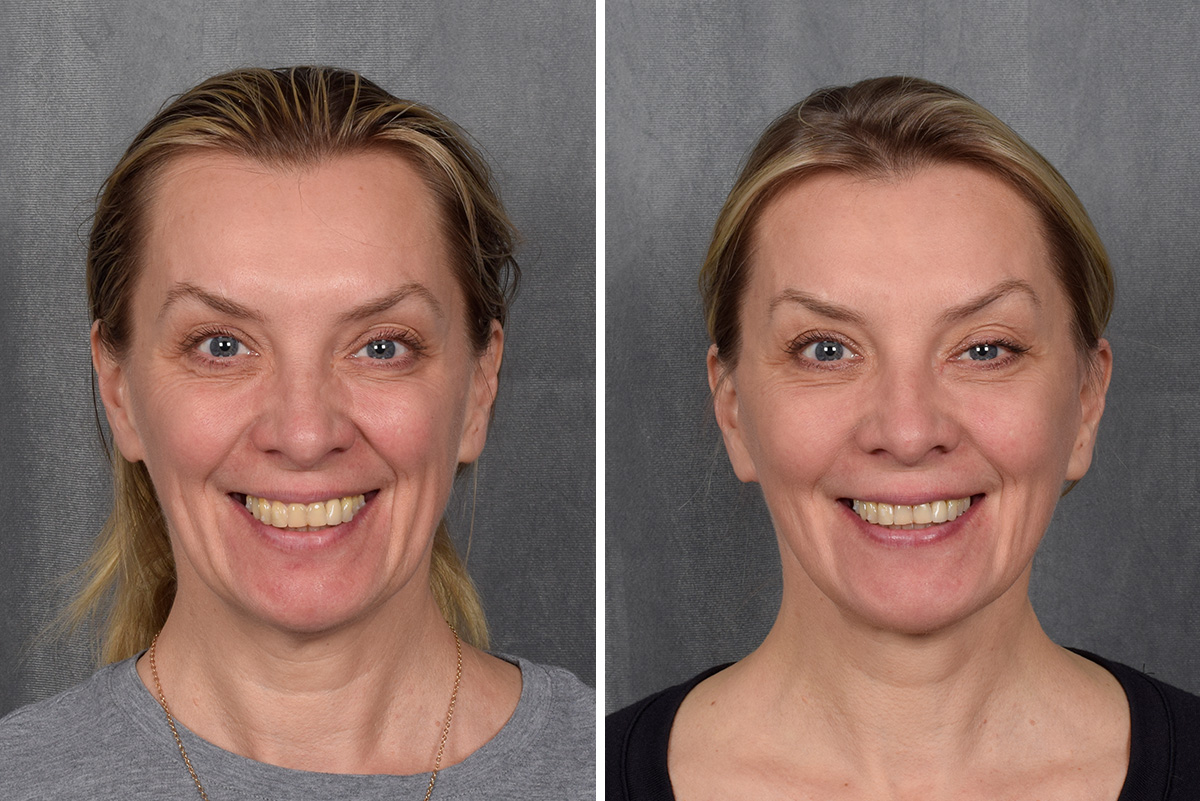 Facelift Before & After Gallery - Patient 365947 - Image 4