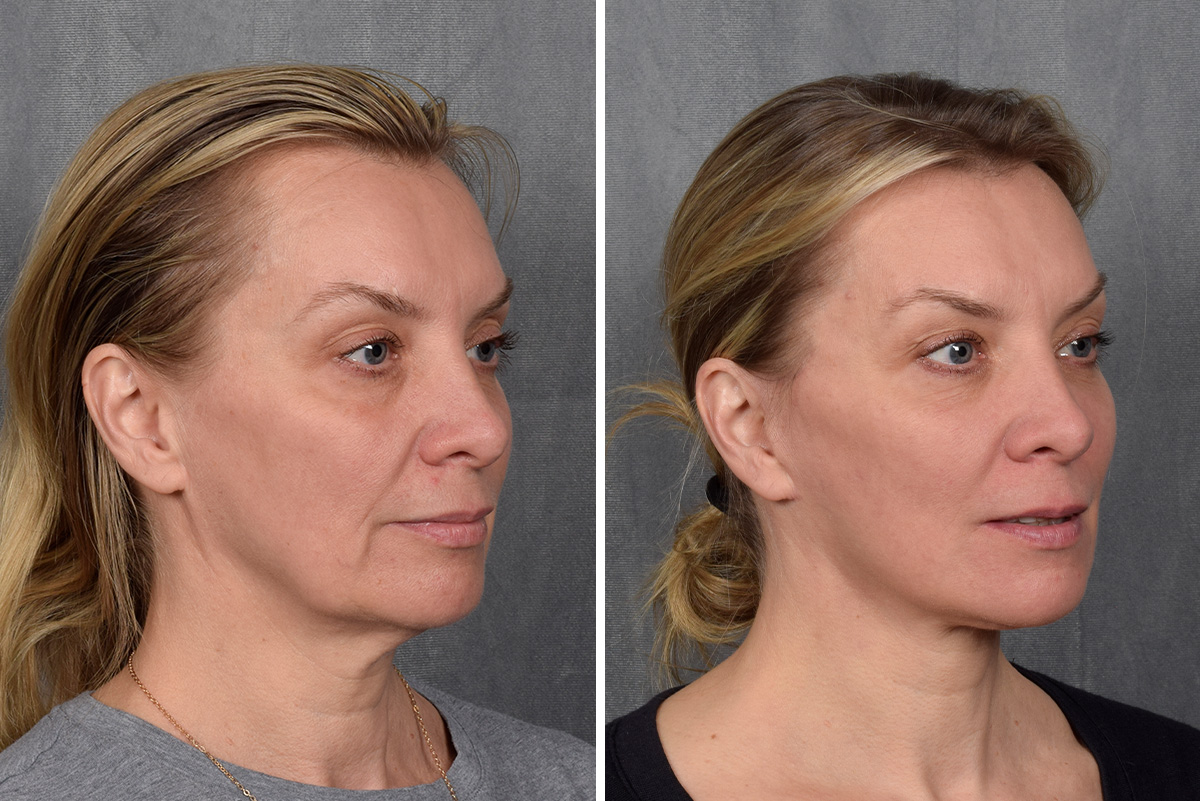Facelift Before & After Gallery - Patient 365947 - Image 5