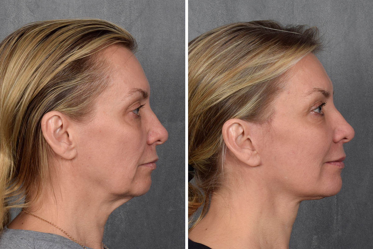 Facelift Before & After Gallery - Patient 365947 - Image 6