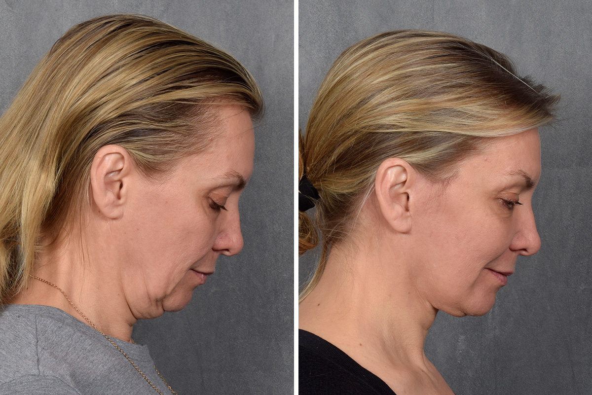 Facelift Before & After Gallery - Patient 365947 - Image 7