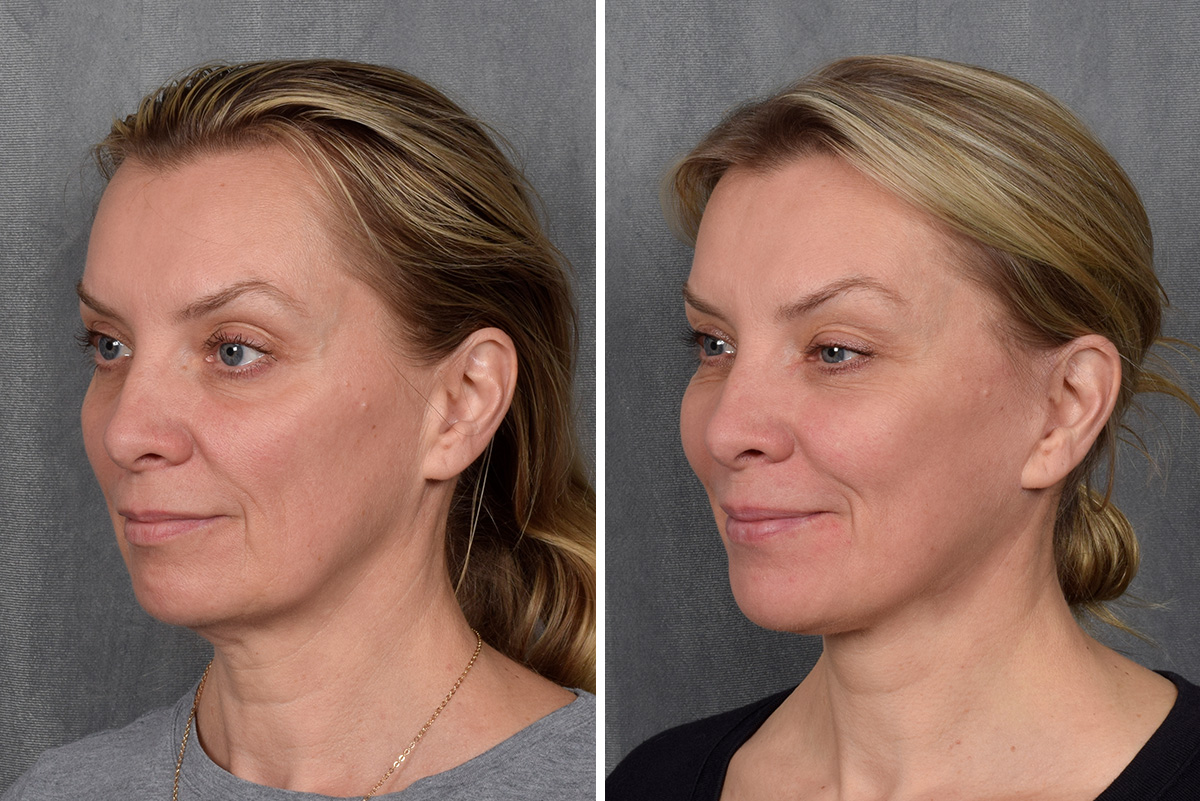 Facelift Before & After Gallery - Patient 365947 - Image 1