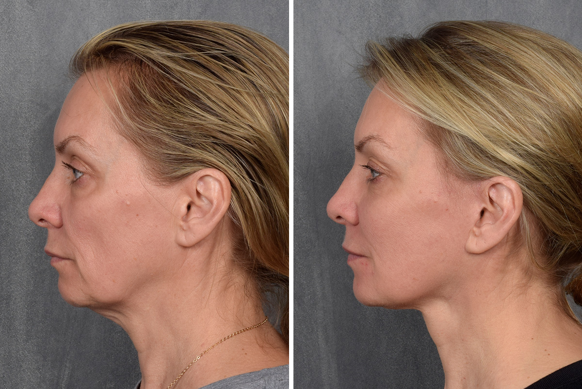 Facelift Before & After Gallery - Patient 365947 - Image 2