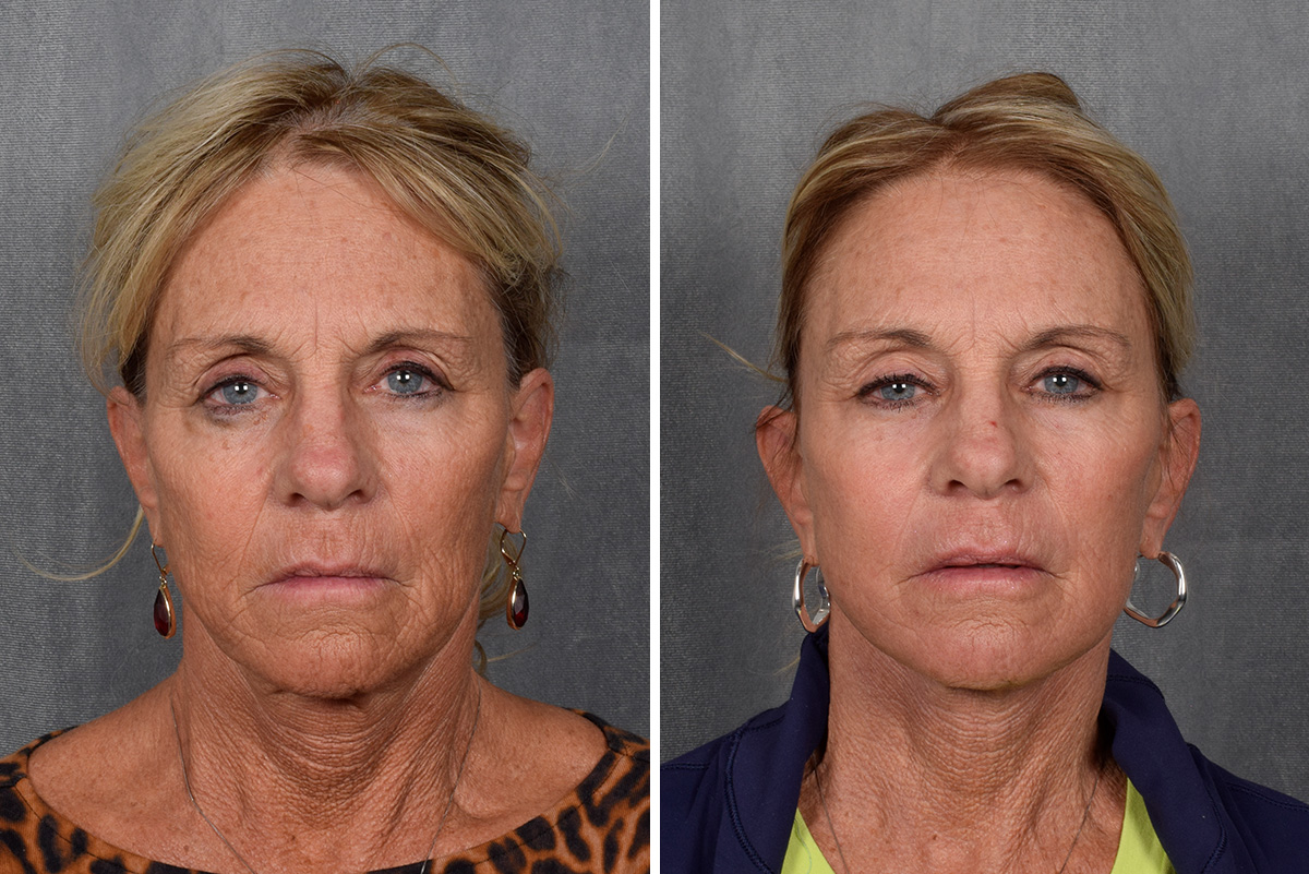 Facelift Before & After Gallery - Patient 640503 - Image 2