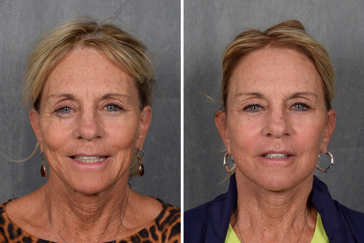 Facelift Before & After Gallery - Patient 640503 - Image 3