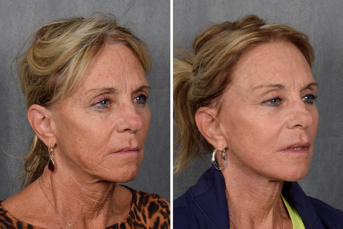 Facelift Before & After Gallery - Patient 640503 - Image 4