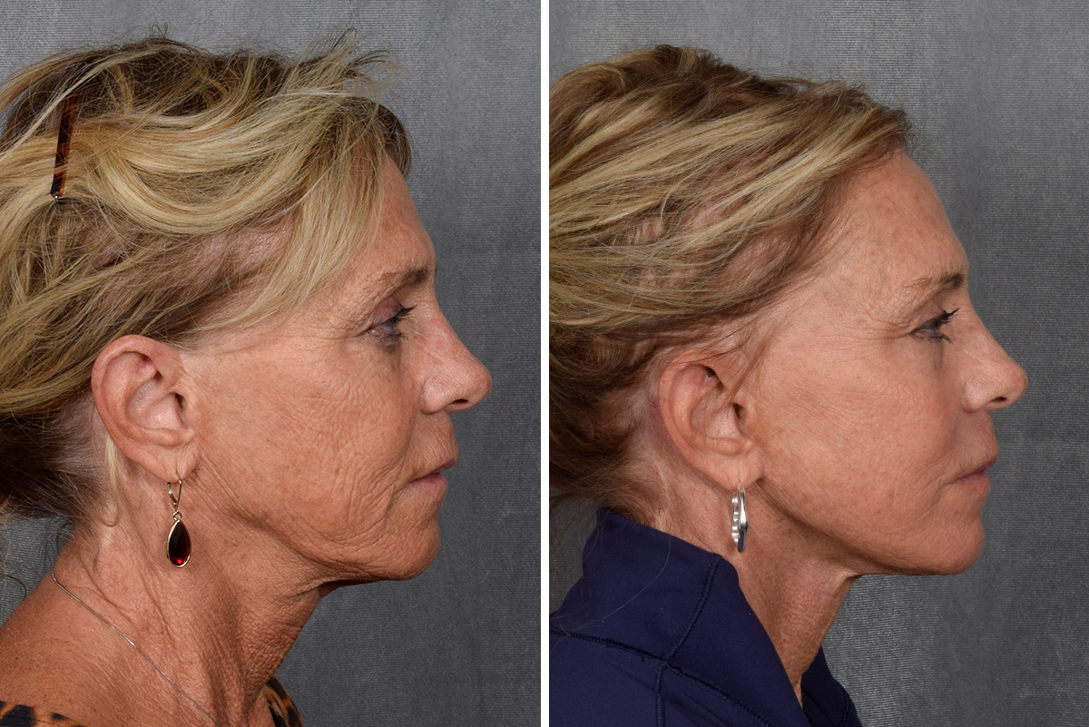 Facelift Before & After Gallery - Patient 640503 - Image 5