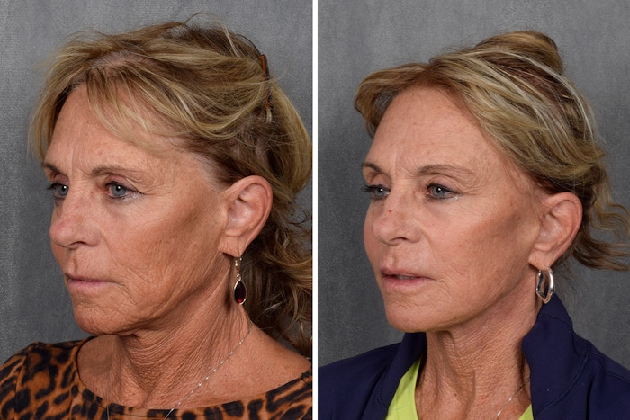 Facelift Before & After Gallery - Patient 640503 - Image 1