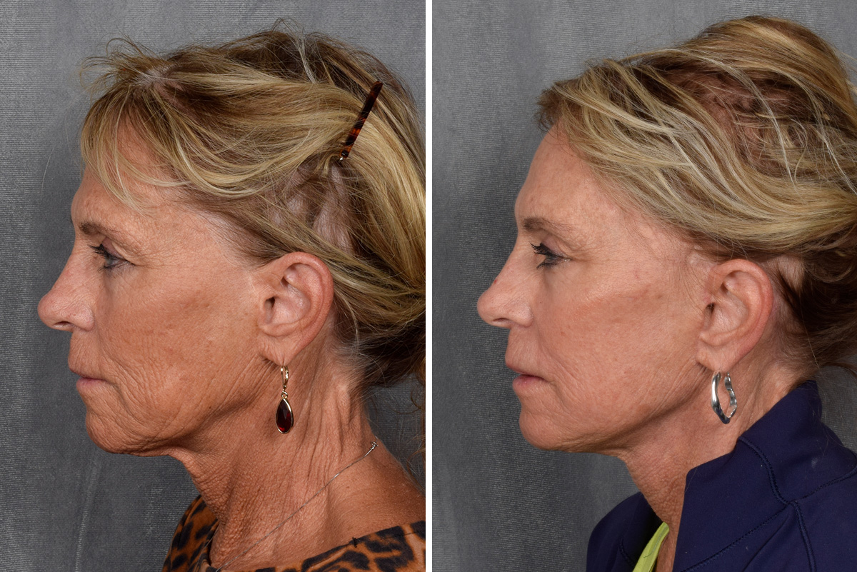 Facelift Before & After Gallery - Patient 640503 - Image 6