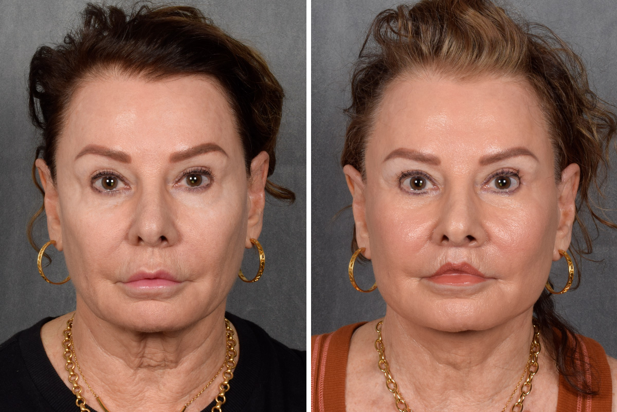 Facelift Before & After Gallery - Patient 301675 - Image 4
