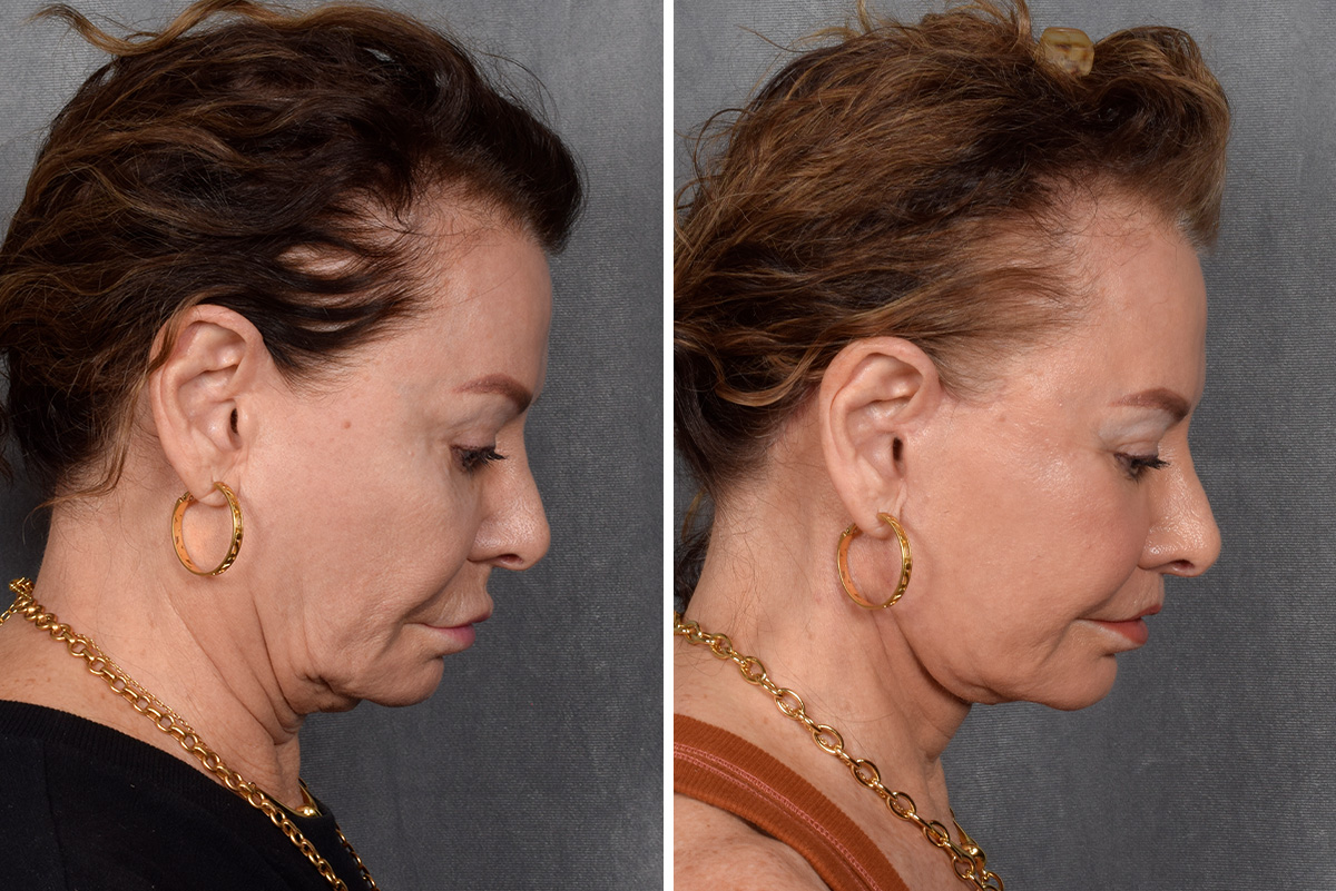 Facelift Before & After Gallery - Patient 301675 - Image 7