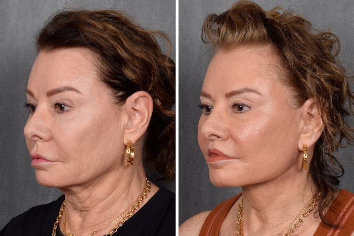 Facelift Before & After Gallery - Patient 301675 - Image 1