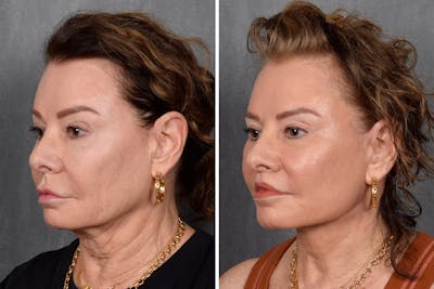 Facelift Before & After Gallery - Patient 301675 - Image 1