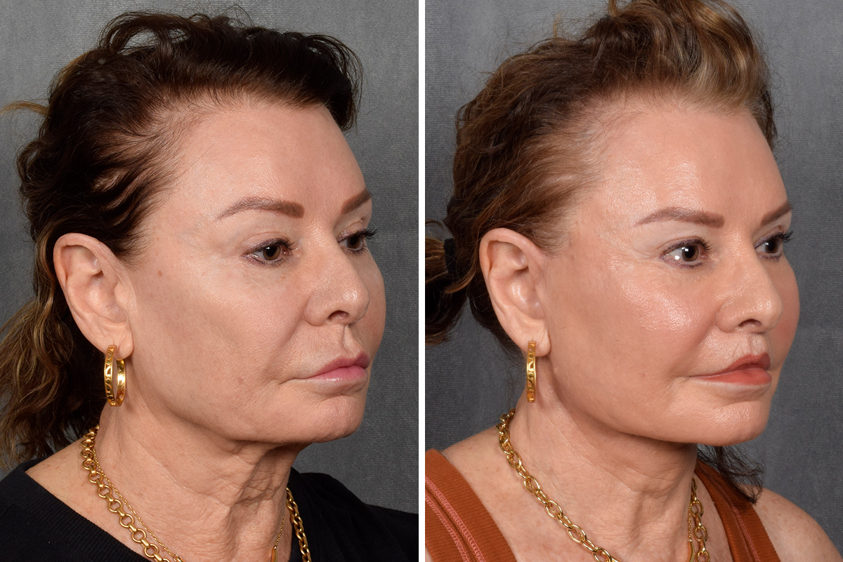 Facelift Before & After Gallery - Patient 301675 - Image 5