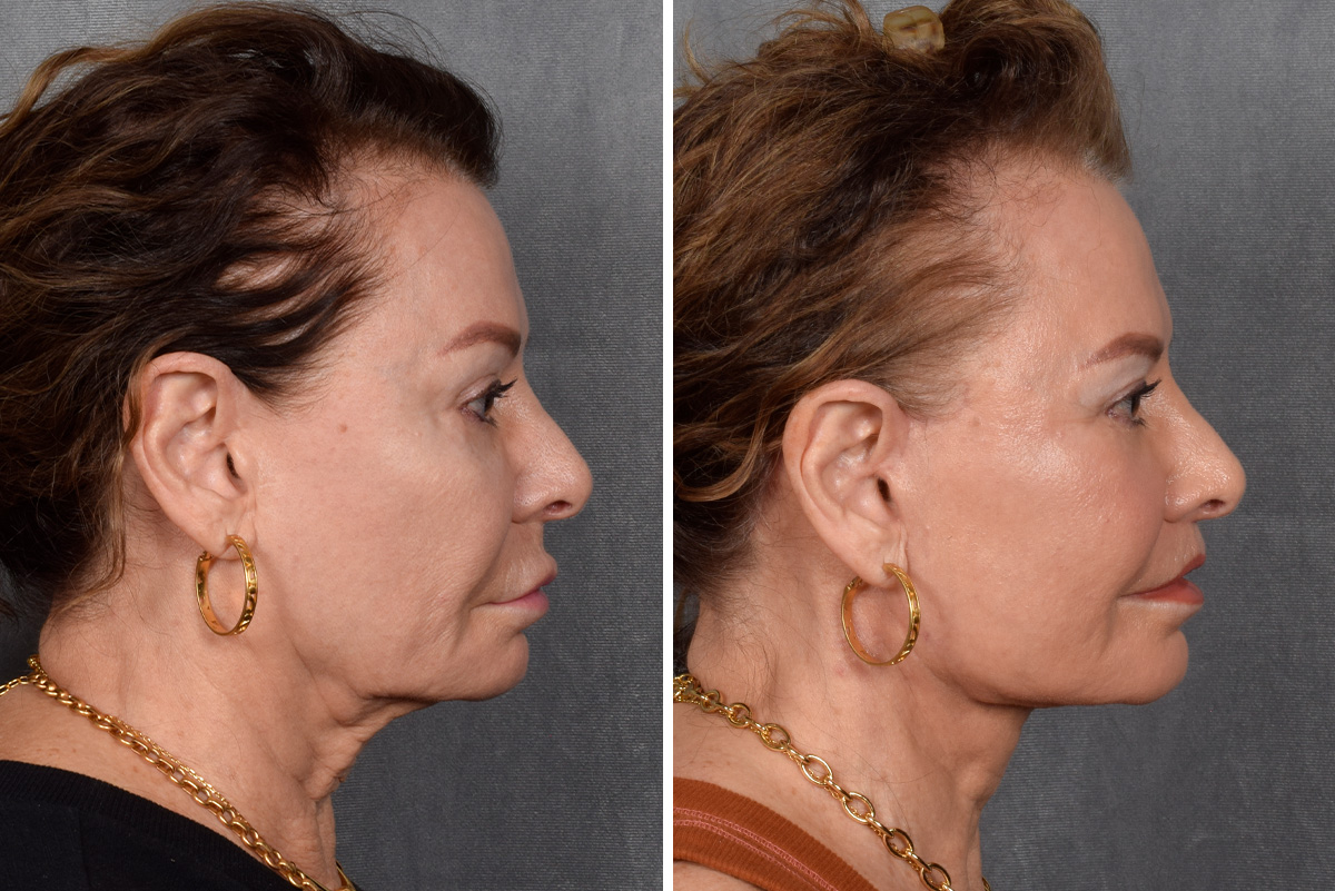 Facelift Before & After Gallery - Patient 301675 - Image 6
