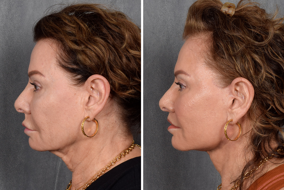 Facelift Before & After Gallery - Patient 301675 - Image 2