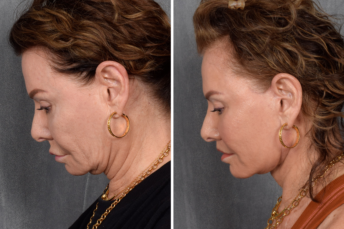 Facelift Before & After Gallery - Patient 301675 - Image 3