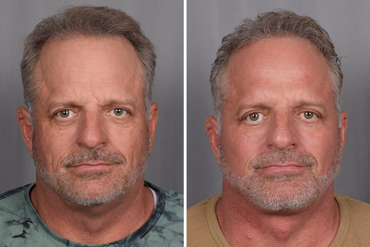 Facelift Before & After Gallery - Patient 337697 - Image 3