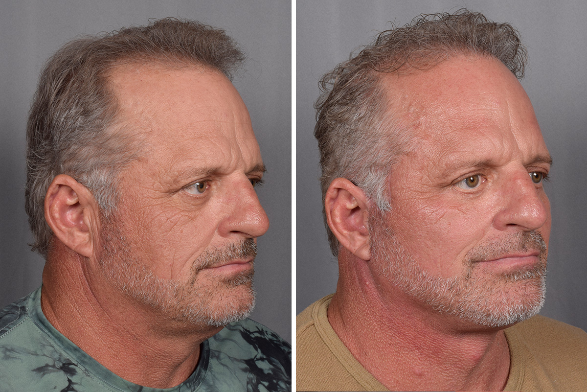 Facelift Before & After Gallery - Patient 337697 - Image 4