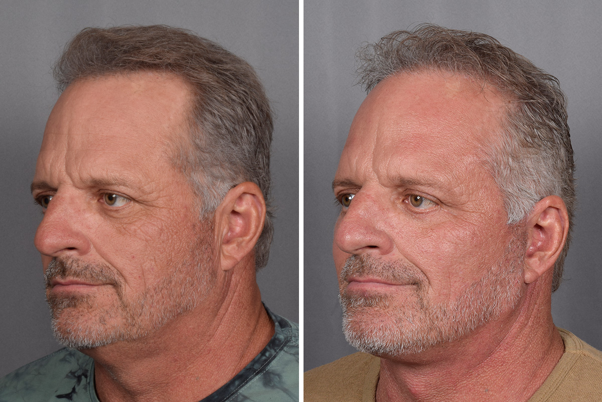 Facelift Before & After Gallery - Patient 337697 - Image 1
