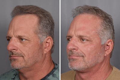 Facelift Before & After Gallery - Patient 337697 - Image 1