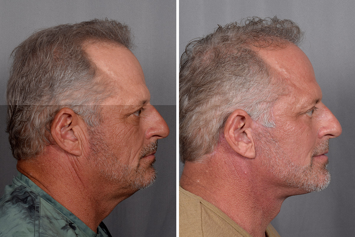 Facelift Before & After Gallery - Patient 337697 - Image 5