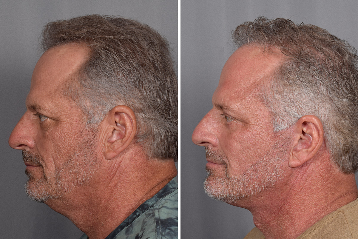 Facelift Before & After Gallery - Patient 337697 - Image 2