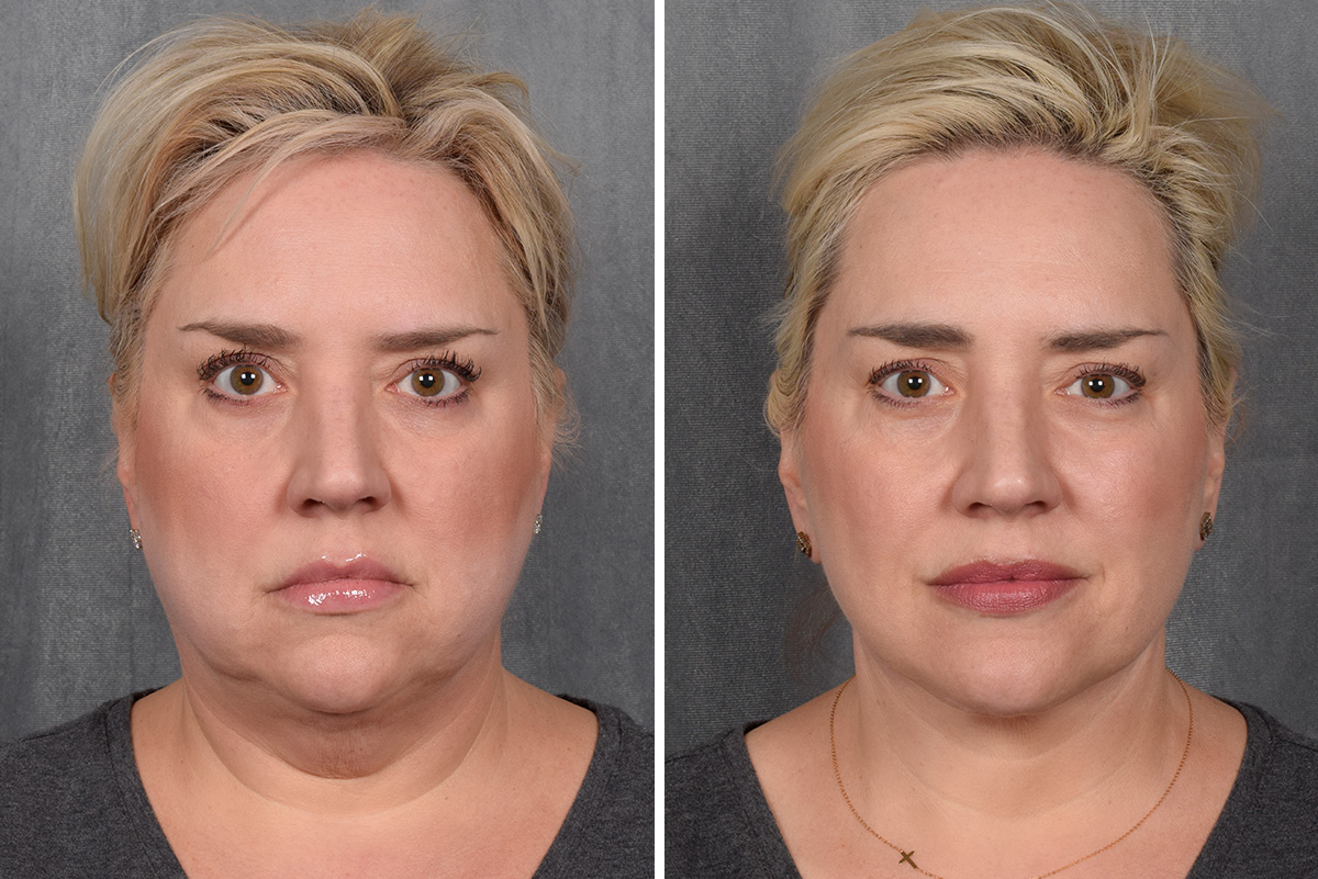 Facelift Before & After Gallery - Patient 410997 - Image 4