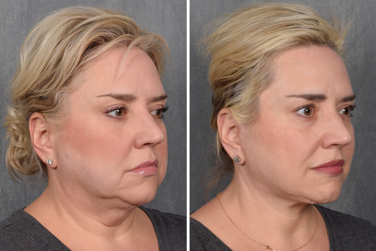 Facelift Before & After Gallery - Patient 410997 - Image 5