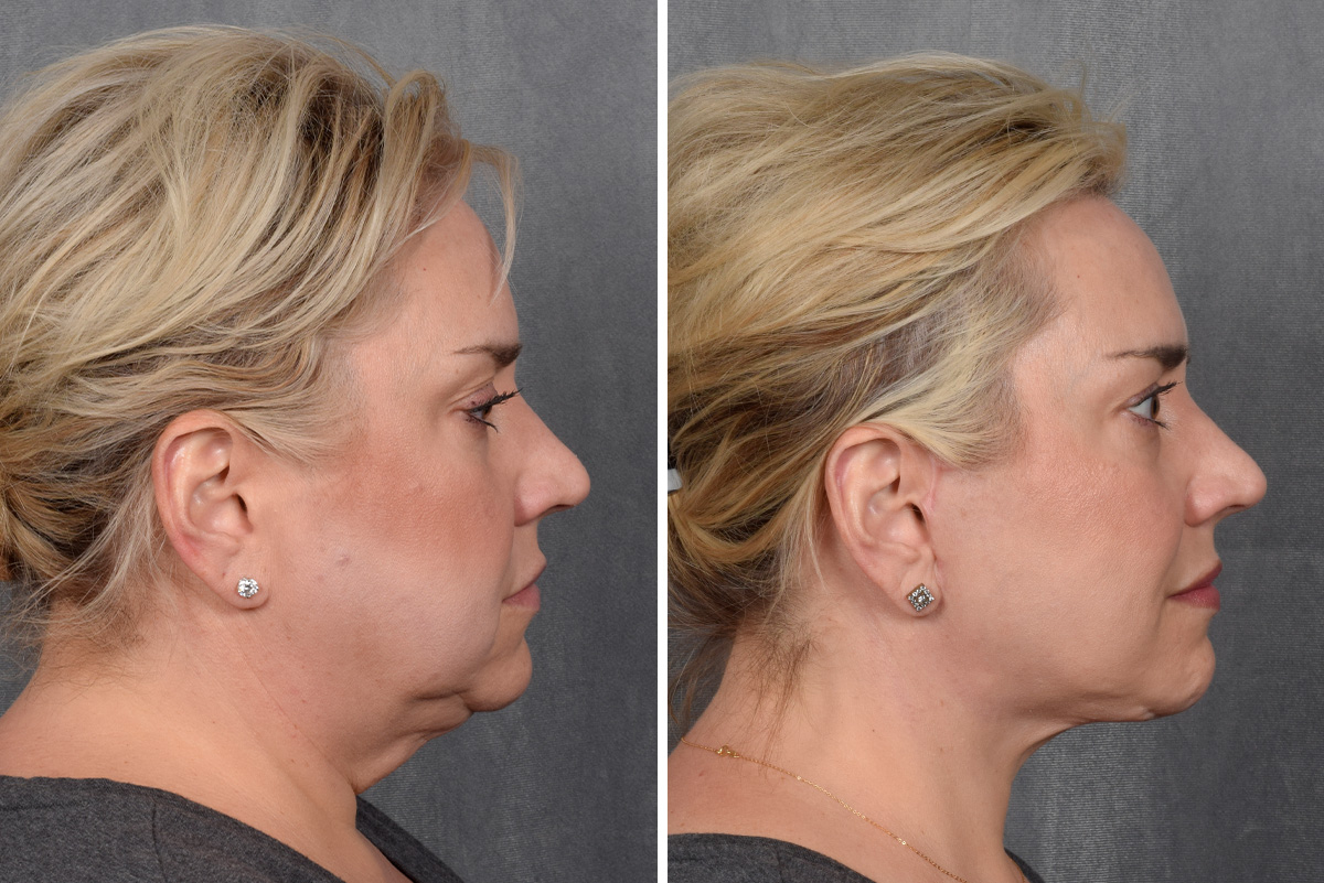 Facelift Before & After Gallery - Patient 410997 - Image 6