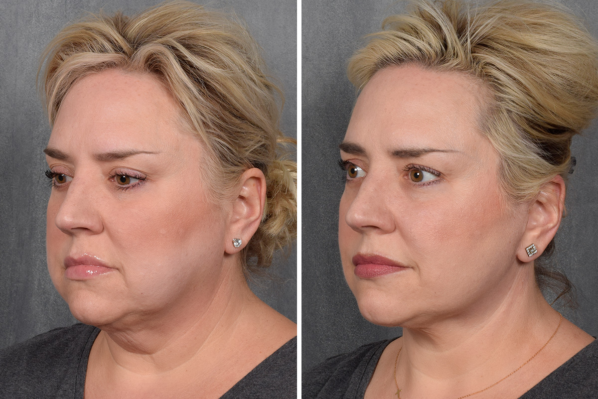 Facelift Before & After Gallery - Patient 410997 - Image 1