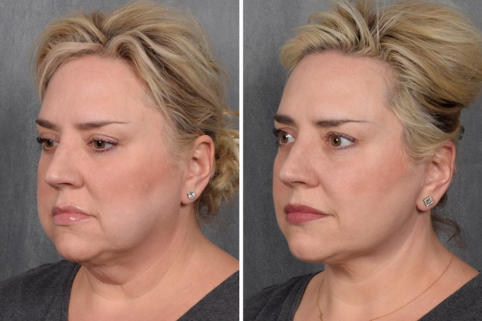 Facelift Before & After Gallery - Patient 410997 - Image 1