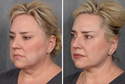 Facelift Before & After Gallery - Patient 410997 - Image 1