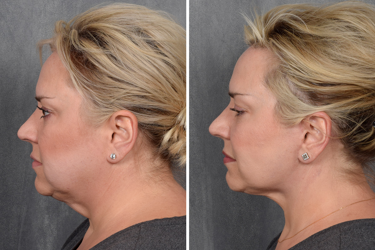 Facelift Before & After Gallery - Patient 410997 - Image 2