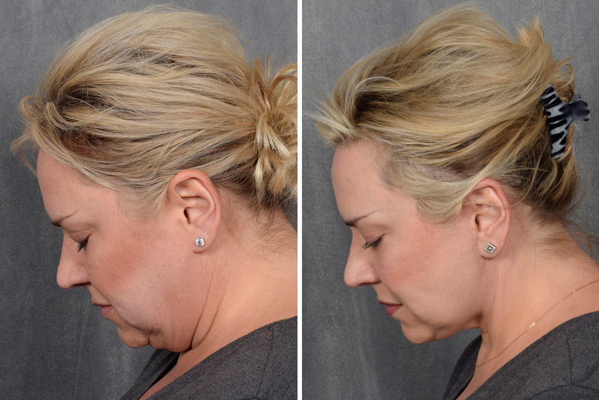 Facelift Before & After Gallery - Patient 410997 - Image 3