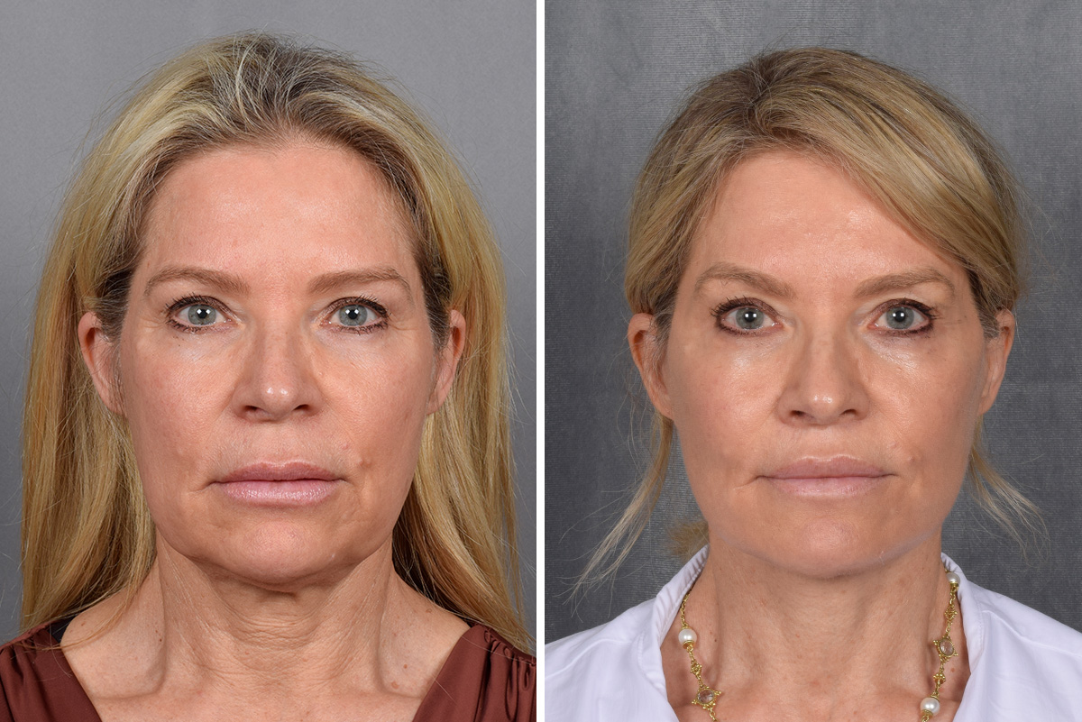 Facelift Before & After Gallery - Patient 110525 - Image 4
