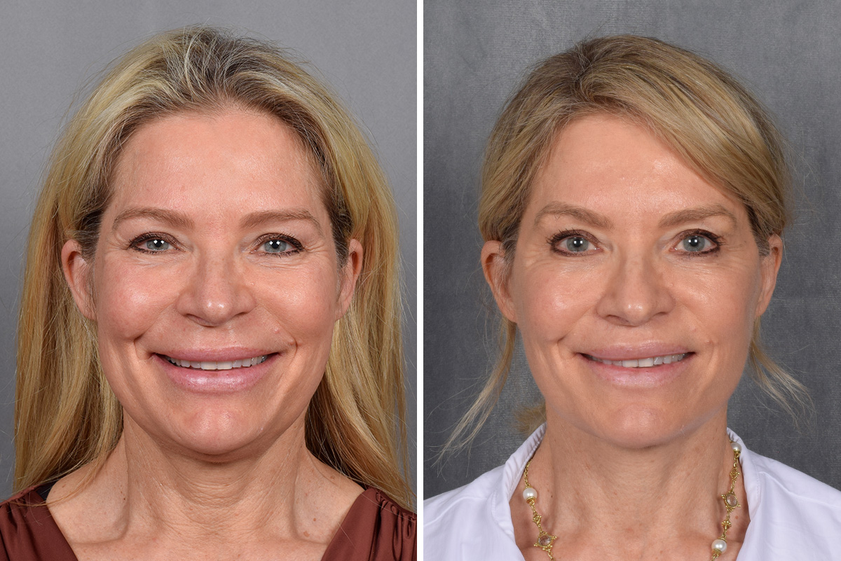 Facelift Before & After Gallery - Patient 110525 - Image 5