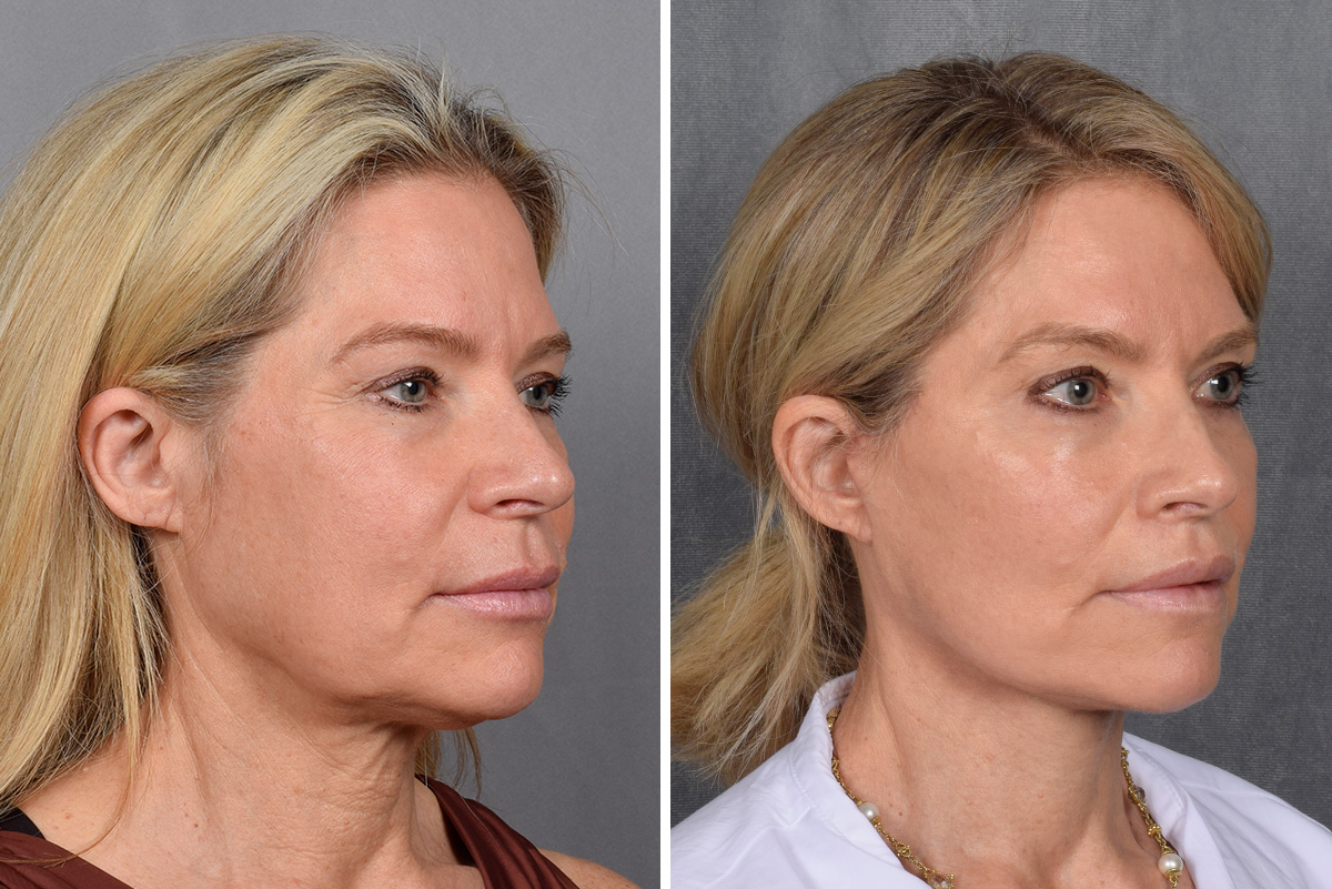 Facelift Before & After Gallery - Patient 110525 - Image 6