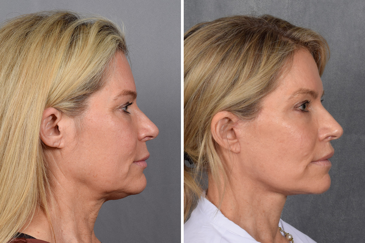 Facelift Before & After Gallery - Patient 110525 - Image 7